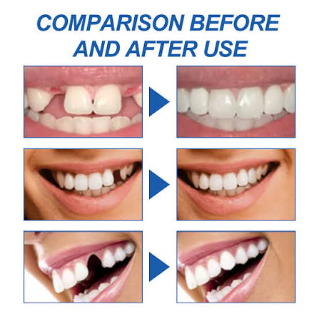 South Moon Solid Dental Gel Fixing Teeth Temporary Filling Cavities Filling Gel Dentures Denture Gap Filling Gel